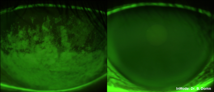 Before and After Forma I